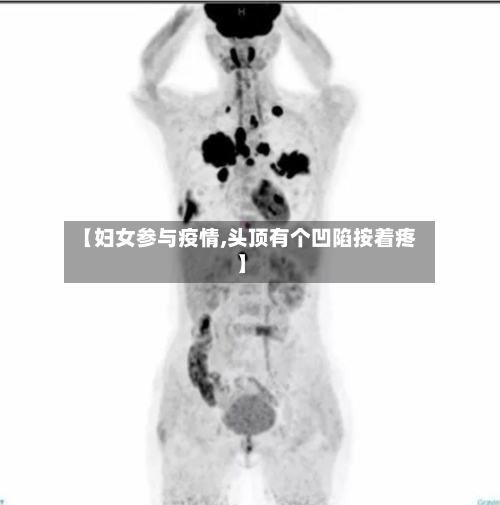 【妇女参与疫情,头顶有个凹陷按着疼】